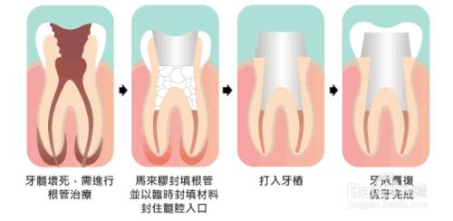 什麼是兒童根管治療以及具體步驟？