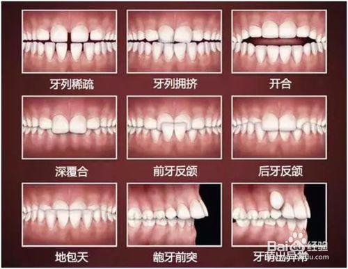 你的孩子需要進行牙齒矯正嗎？