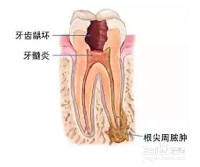 什麼是根管治療？