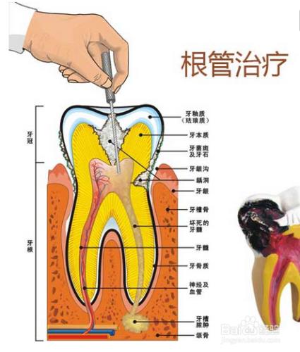 什麼是根管治療？