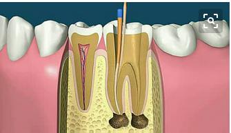 什麼是根管治療？