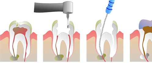 什麼是根管治療？