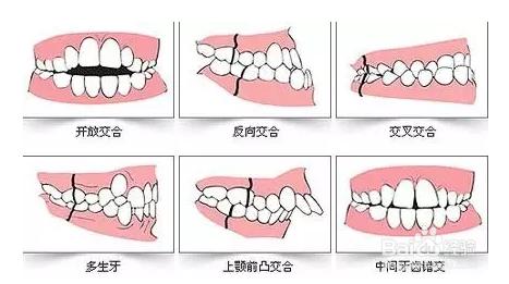 不給兒童做牙齒矯正的危害！