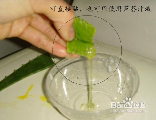 寶寶臉上被蚊子咬了怎麼辦