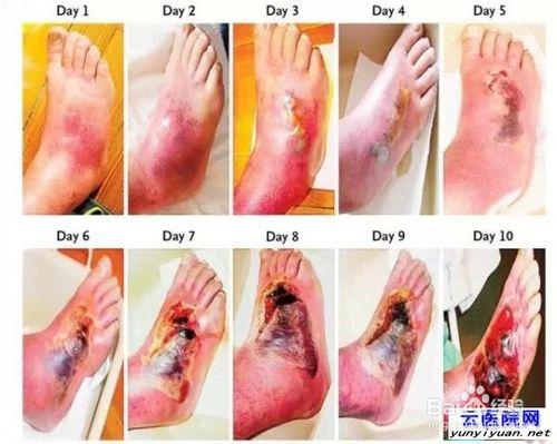 糖尿病足的預防和治療方法