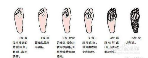 糖尿病足的預防和治療方法