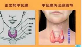 甲狀腺患者的症狀