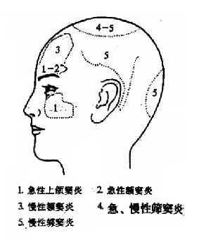 為什麼年輕人容易得鼻竇炎？