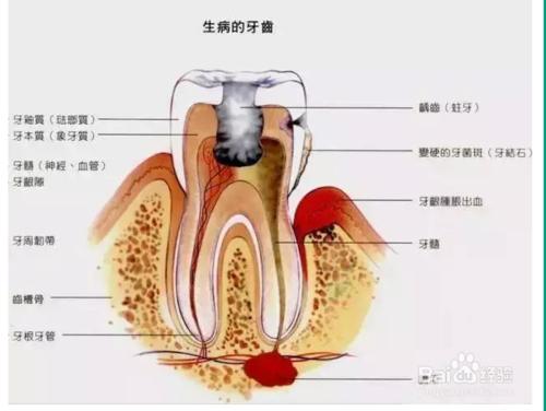 洗牙真的好嗎