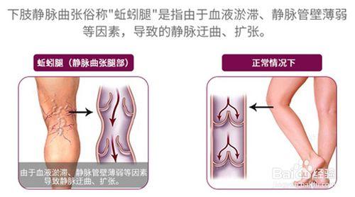 靜脈曲張的預防和護理