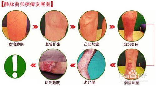 靜脈曲張的預防和護理