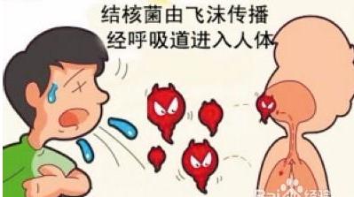 肺結核根治方法