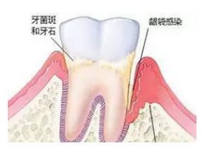 如何快速去除牙結石？