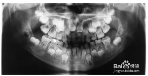 融合牙與多牙少牙是常見的乳牙換牙期異常