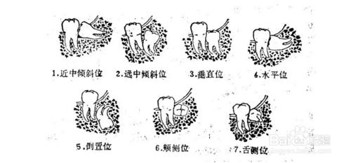 融合牙與多牙少牙是常見的乳牙換牙期異常