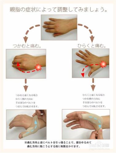 大拇指腱鞘炎的病因和治療方法