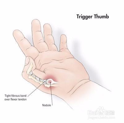 大拇指腱鞘炎的病因和治療方法