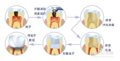 根管治療後做全冠的原因