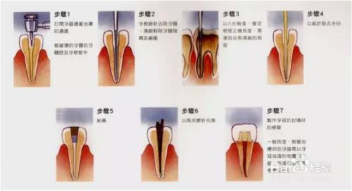 根管治療後做全冠的原因