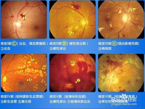 視力減退！糖尿病所發出的“求救”訊號