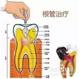 根管治療後做全冠的原因