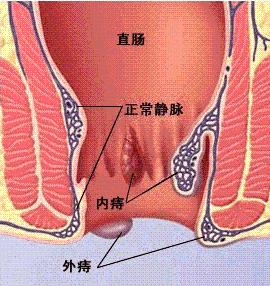 軟椅容易導致痔瘡