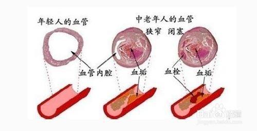 血管堵塞的原因，血管堵塞治療方法