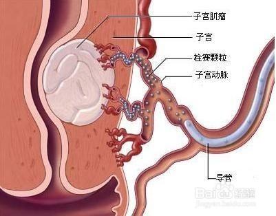 漿膜下子宮肌瘤有什麼危害？