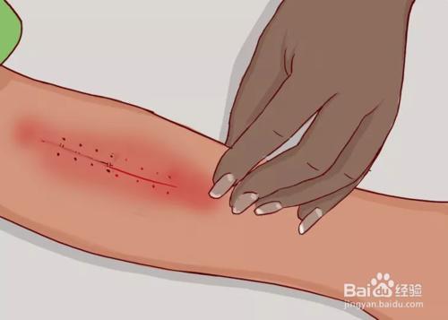 用醫用釘皮機進行傷口閉合後，怎麼拆釘？